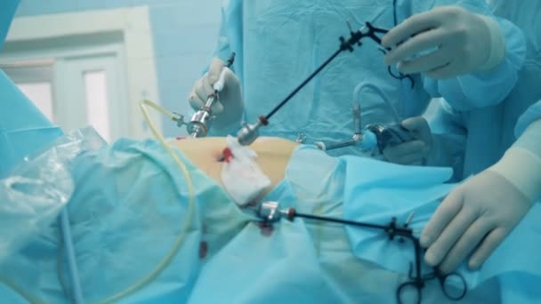 Orvos lebontják sebészeti rúd alatt laparoszkópia — Stock videók
