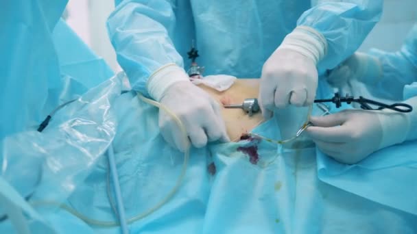 Хирург связывает медицинскую трубку, вставленную в живот человека — стоковое видео