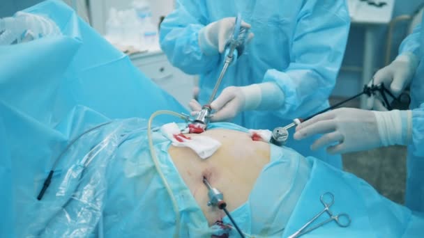 Cavidad abdominal con varillas metálicas insertadas en ella y controladas por médicos — Vídeos de Stock