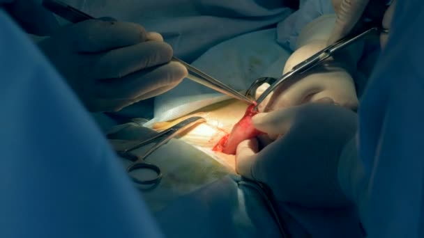 Close up of a major surgery performed by a team of doctors — Stock Video
