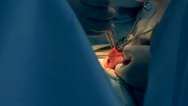 操作中に、外科医が臓器で、口を作っています。 — ストック動画