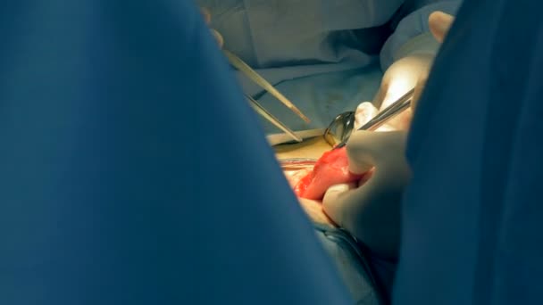 Chirurgen machen während der Operation ein Ostium in einem Organ — Stockvideo