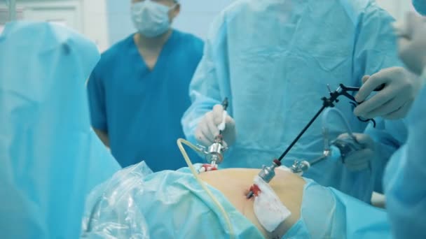 Ομάδα χειρουργών εκτελούν μια λειτουργία σε μια κοιλιακή κοιλότητα — Αρχείο Βίντεο