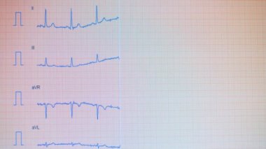 Elektrokardiyografik eğrilikleri üzerinde çizilmiş alıyorsanız ile ekran. Kalp nabız hattı.