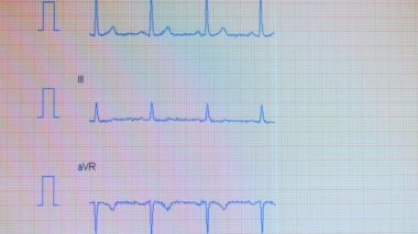 kalp nabız hattı. Elektrokardiyografi işlemi bir ekranda gösterdi.