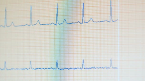 Medical monitor with changing readings of EKG. ECG monitor shows healthy heart beat. — Stock Video