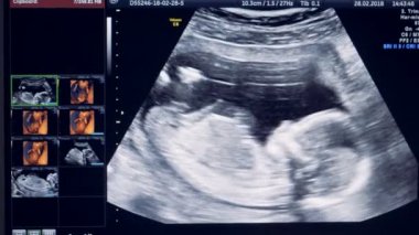 Ultrason monitör üzerinde görüntülenen küçük bebek