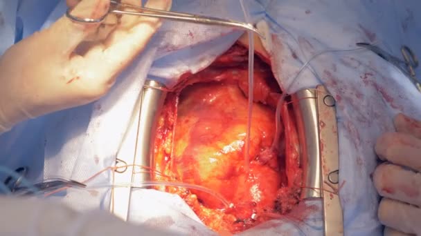 Heart surgery at a hospital, close up. Doctors perform an open heart surgery at a clinic. — Stock Video