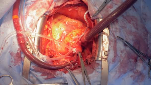 Patients heart during a surgery. An open heart surgery at a hospital. — Stock Video