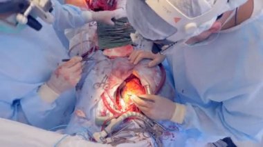 İşlem açık kalp cerrahisi, üstten görünüm.