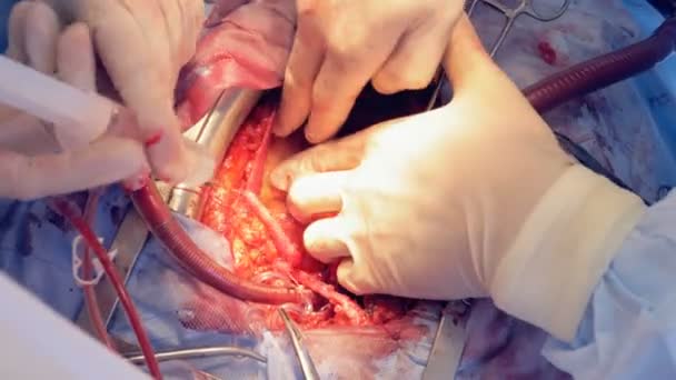 Surgeons working on an open heart, close up. — Stock Video