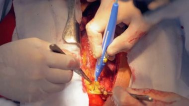 Neşter bir ameliyat sırasında doktorlarla yakın çekim.
