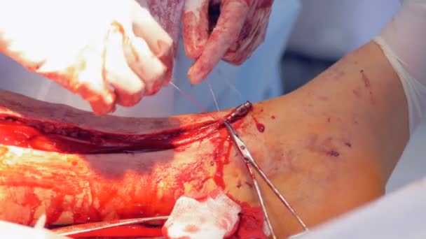 Two surgeons performing a heart operation, stitching an incision. 4K. — Stock Video