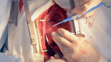 Açık kalp kesi, üstten görünüm.