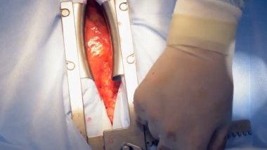 Cerrahlar kümesi bir kalp forseps, yakın çekim.