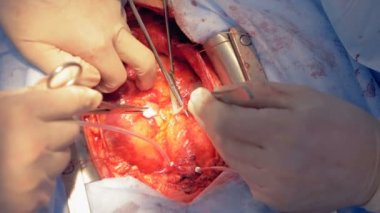 Hastalar kalp, dikiş cerrahlar yakın çekim.