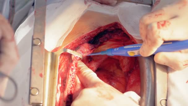 Chirurgen werken in een kamer, op een patiënten-hart. — Stockvideo