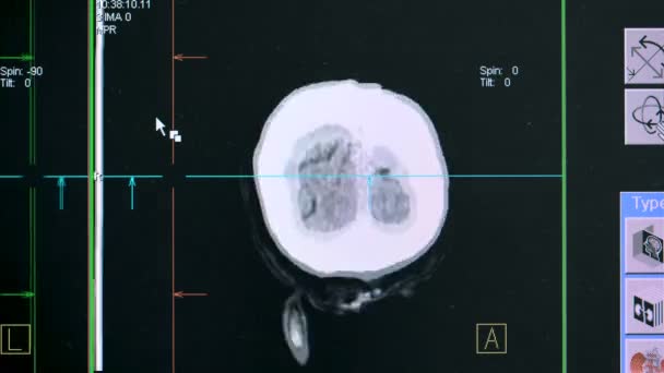 Primo piano di un caso di cervello viene visualizzato durante la procedura di scansione — Video Stock