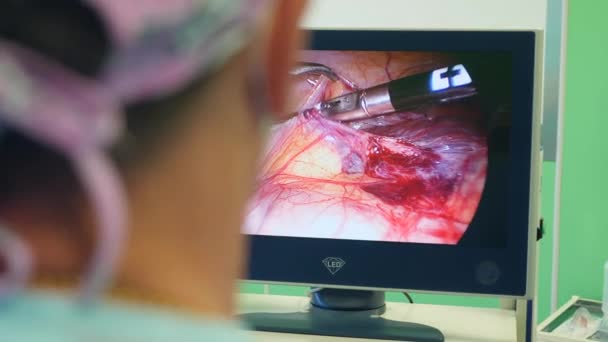 Course of surgery is being shown on a screen — Stock Video