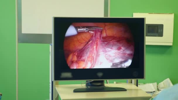 Course of surgery is getting demonstrated on a display — Stock Video