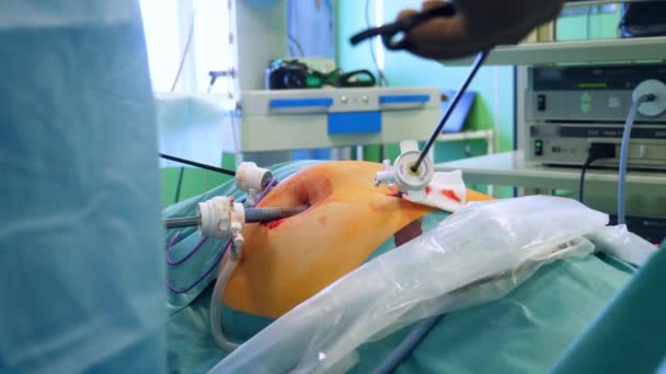 Врач проводит операцию на пациенте, используя металлические инструменты . — стоковое видео