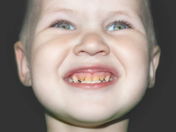 Широка Посмішка Хлопчиків Демонструє Неправильний Догляд Ротовою Порожниною Зубами — стокове фото