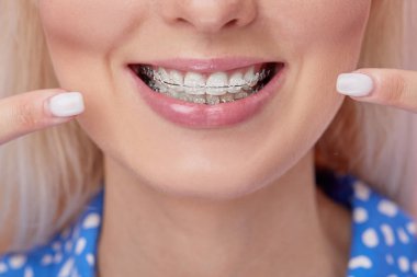 Diş telleriyle güzel makro çekimler. Diş bakımı fotoğrafı. Güzel kadın ortodontik aksesuarlarla gülümsüyor. Ortodonti tedavisi. Sağlıklı kadın ağzının kapanışı