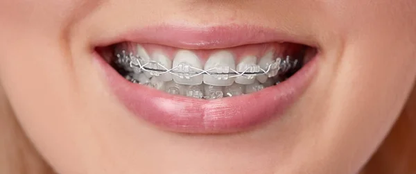 Diş telleriyle güzel makro çekimler. Diş bakımı fotoğrafı. Güzel kadın ortodontik aksesuarlarla gülümsüyor. Ortodonti tedavisi. Sağlıklı kadın ağzının kapanışı