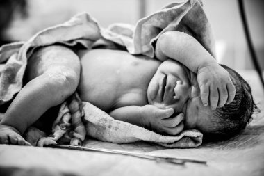 A newborn with a freshly cut umbilical cord lies on a table in the operating room. clipart
