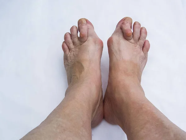 Los Pies Desnudos Que Tienen Hallux Valgus Juanete Problema — Foto de Stock