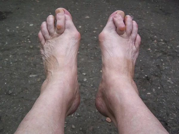 Bosé Nohy Které Mají Hallux Valgus Problém — Stock fotografie