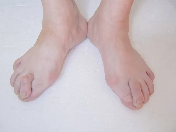 Los pies desnudos que tienen Hallux Valgus problema . — Foto de Stock