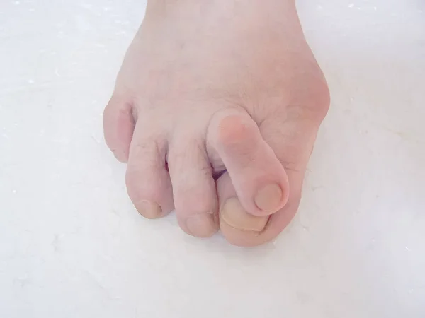 Los pies desnudos que tienen Hallux Valgus problema . — Foto de Stock