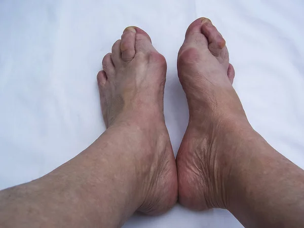 Los pies desnudos que tienen Hallux Valgus problema . Fotos De Stock