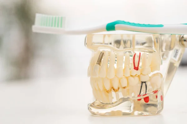 Conjunto Herramientas Equipo Del Dentista Prótesis Que Muestra Implante —  Fotos de Stock
