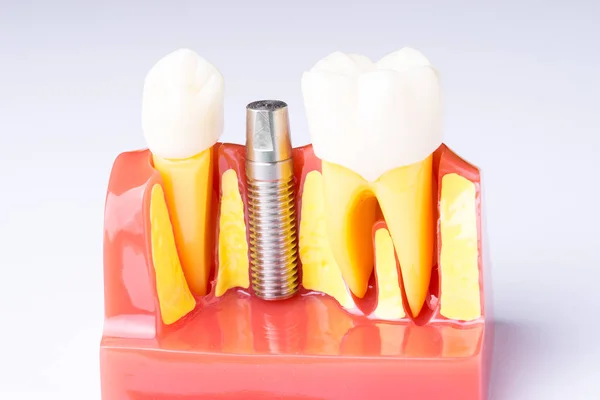 Ensemble Outils Équipement Dentiste Prothèse Dentaire Montrant Implant — Photo