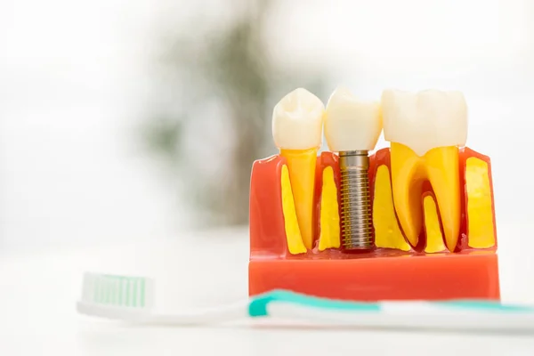 Conjunto Herramientas Equipo Del Dentista Prótesis Que Muestra Implante —  Fotos de Stock
