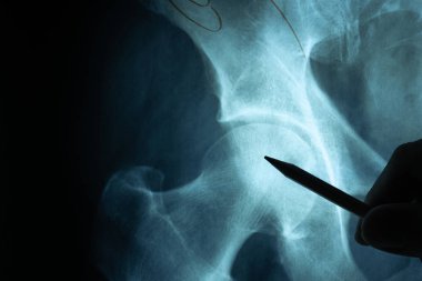 İncelemek için doktor eli ile röntgen filmi.