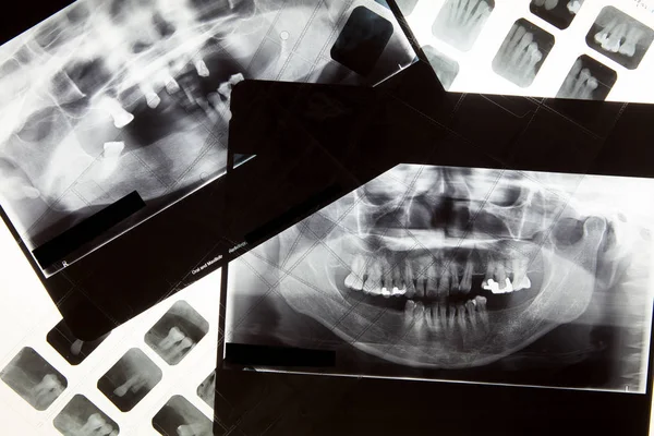 Película de rayos X dental para el concepto de cuidado dental — Foto de Stock
