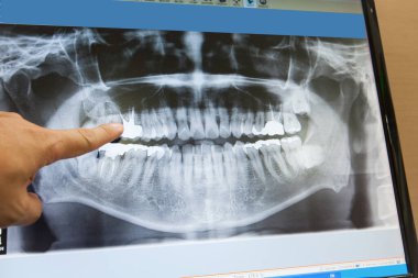 Diş sağlığı konsepti için diş röntgeni filmi