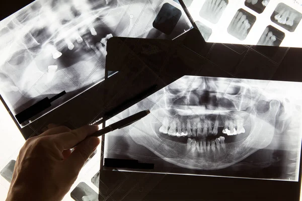 Dental x ray film for dental care concept — Stock Photo, Image