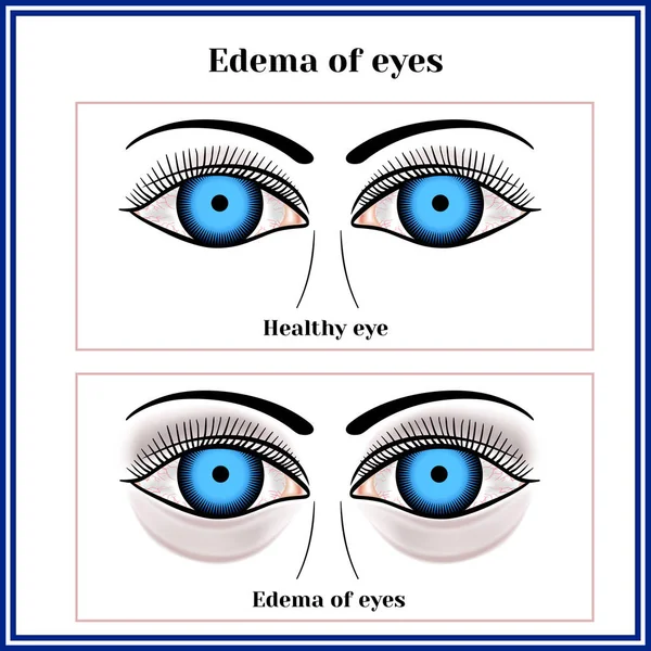 Otoky Očí Zdravé Oči — Stockový vektor