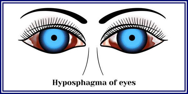 Hyposphagma of eyes — Stock Vector