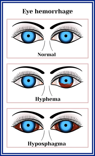 Hemorragia ocular — Vector de stock