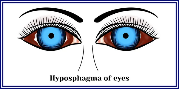 Hipoesfagma de los ojos Gráficos Vectoriales