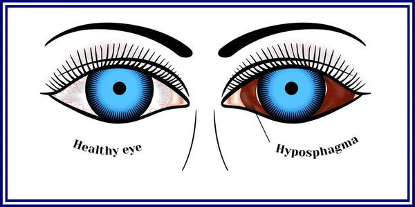 Hyposphagma des yeux Vecteur En Vente