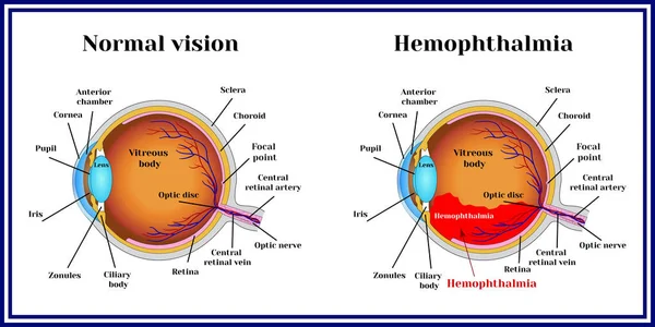 Hemoftalmia Ilustraciones De Stock Sin Royalties Gratis