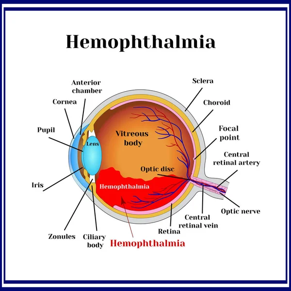 Hemophthalmia Presence Blood Vitreous Body Sometimes Called Hemorrhage Eyeball — Stock Vector