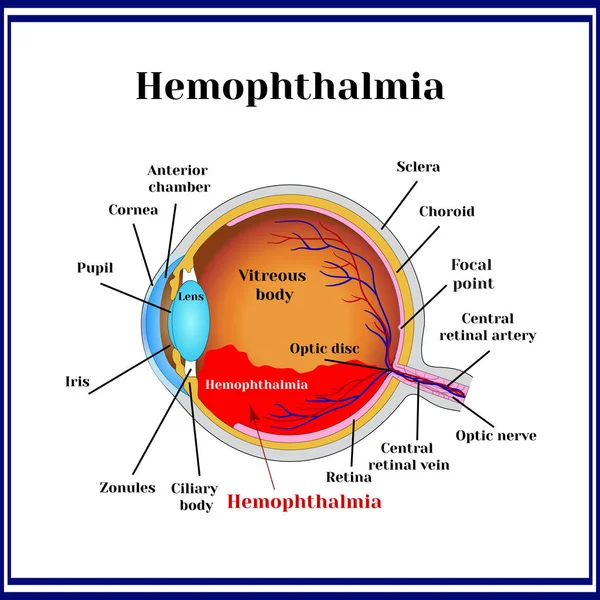 血球血症 静脈体内の血液の存在 眼球の出血と呼ばれることもある ストックイラスト