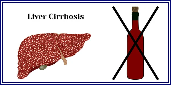 Cirrosis. Violación de la estructura hepática . — Vector de stock